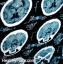 Povezava med travmatično poškodbo možganov in boj proti PTSP