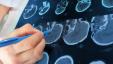 3D skeniranje možganov lahko poveča natančnost diagnoze ADHD