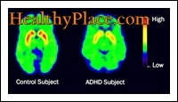 Izraza ADD in ADHD sta bila zamenljiva. Vendar je posodobljeni izraz, v skladu z DSM IV, ADHD (hiperaktivna motnja s pomanjkanjem pozornosti).